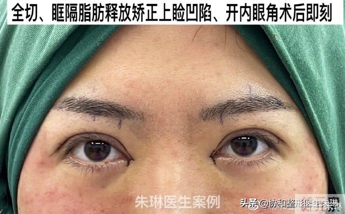 眼整形功课系列:不是所有的睁眼抬眉都需要 图片-3
