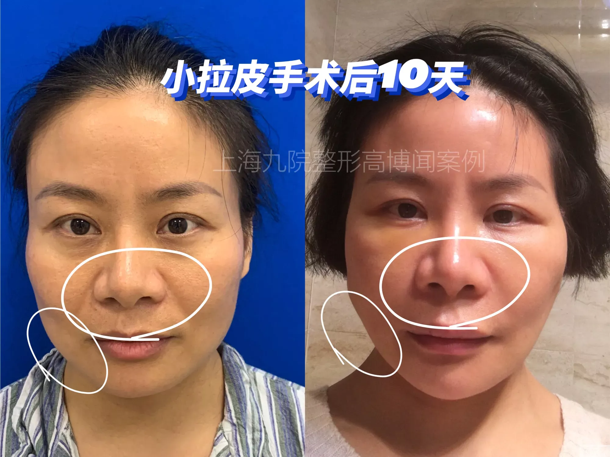 小拉皮切口是不是越小越好? 图片-2