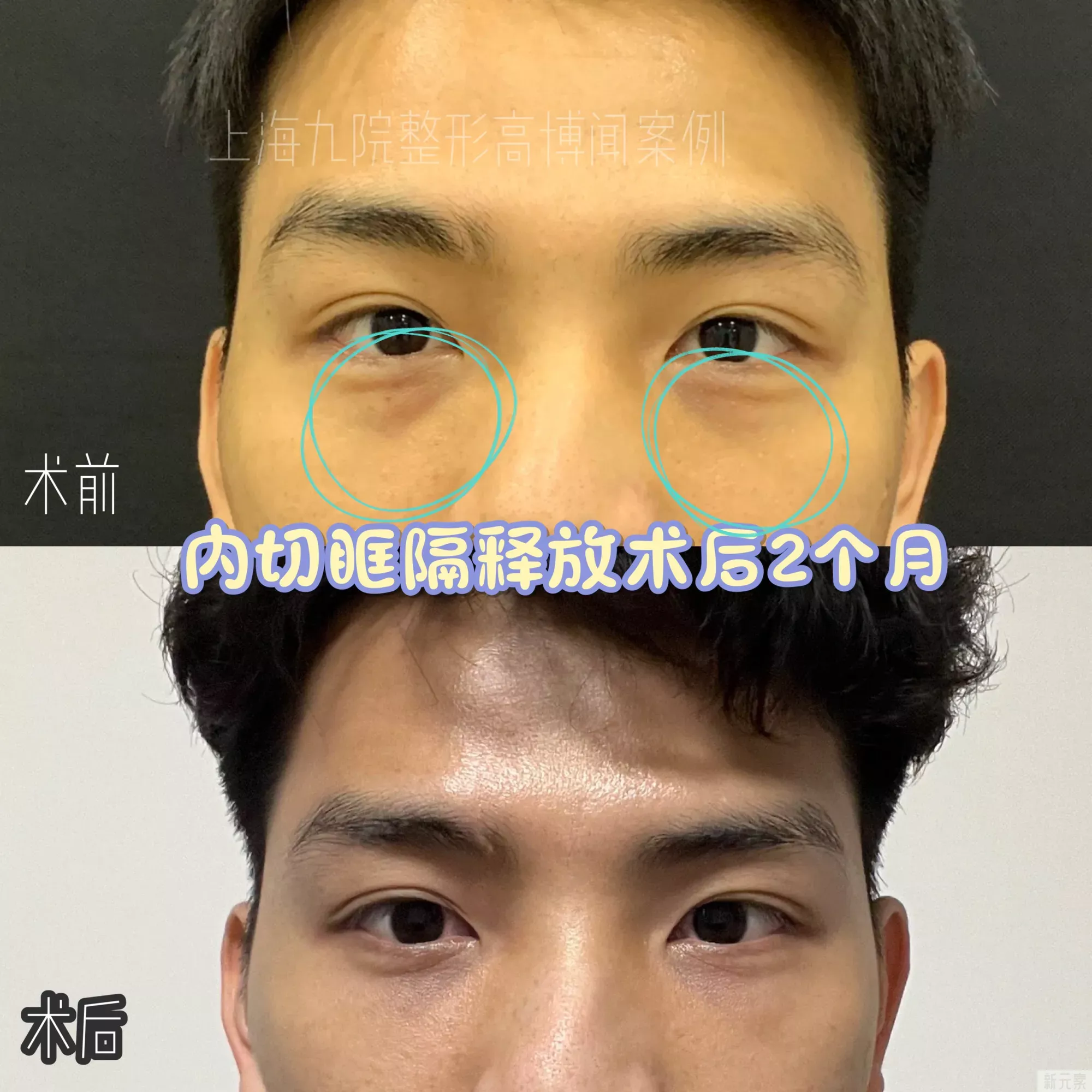 ❓做了内切眼袋手术第几天最肿啊?啥时候可 图片-2