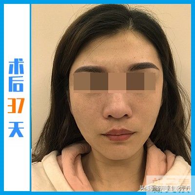 一开始我以为“拉皮很可怕”,当真正经历过 图片-3