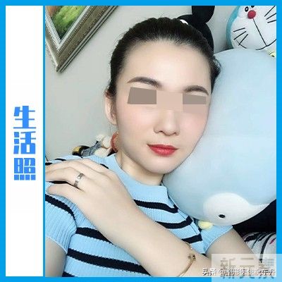 一开始我以为“拉皮很可怕”,当真正经历过 图片-6