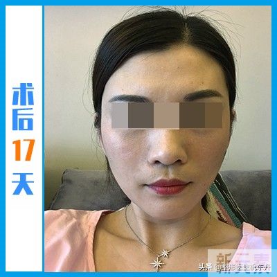 一开始我以为“拉皮很可怕”,当真正经历过 图片-2