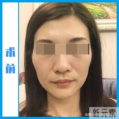 一开始我以为“拉皮很可怕”,当真正经历过 图片-1