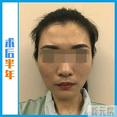 一开始我以为“拉皮很可怕”,当真正经历过 图片-5