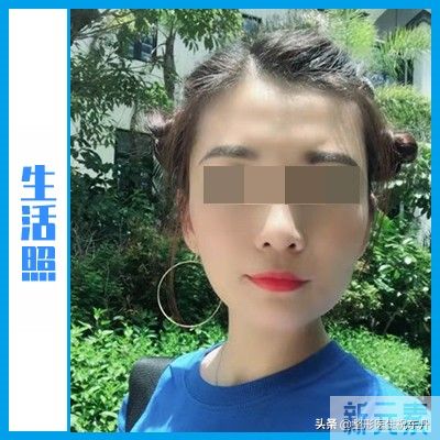 一开始我以为“拉皮很可怕”,当真正经历过 图片-8