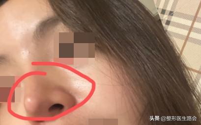 做完膨体耳软骨鼻综合一个月了。鼻孔有点外露。会不会挛缩了? 图片-1