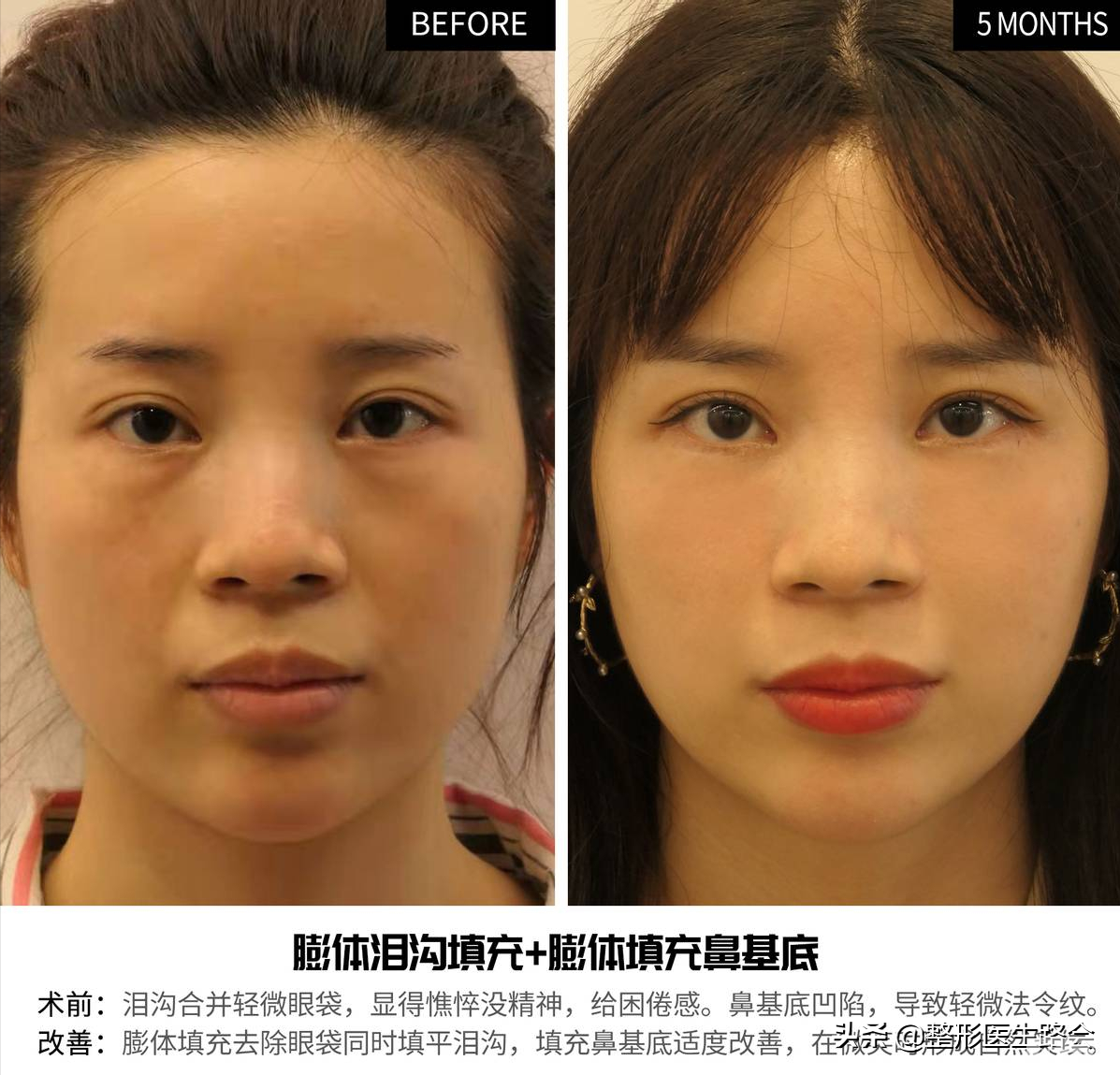 关于玻尿酸隆鼻、填充太阳穴、泪沟,那些医生不会告诉你的 图片-8