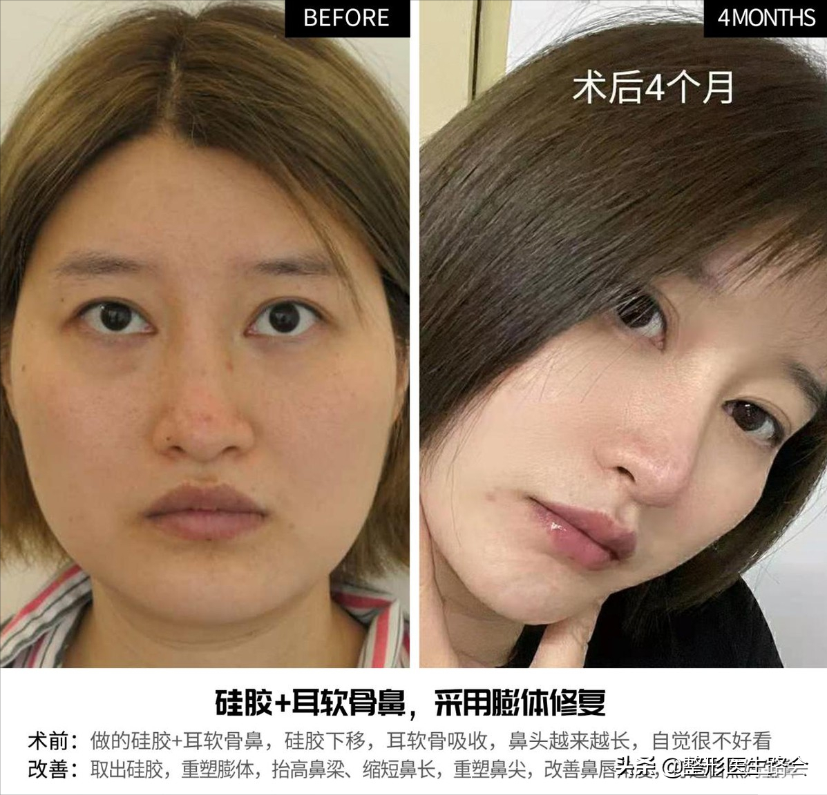 关于玻尿酸隆鼻、填充太阳穴、泪沟,那些医生不会告诉你的 图片-9