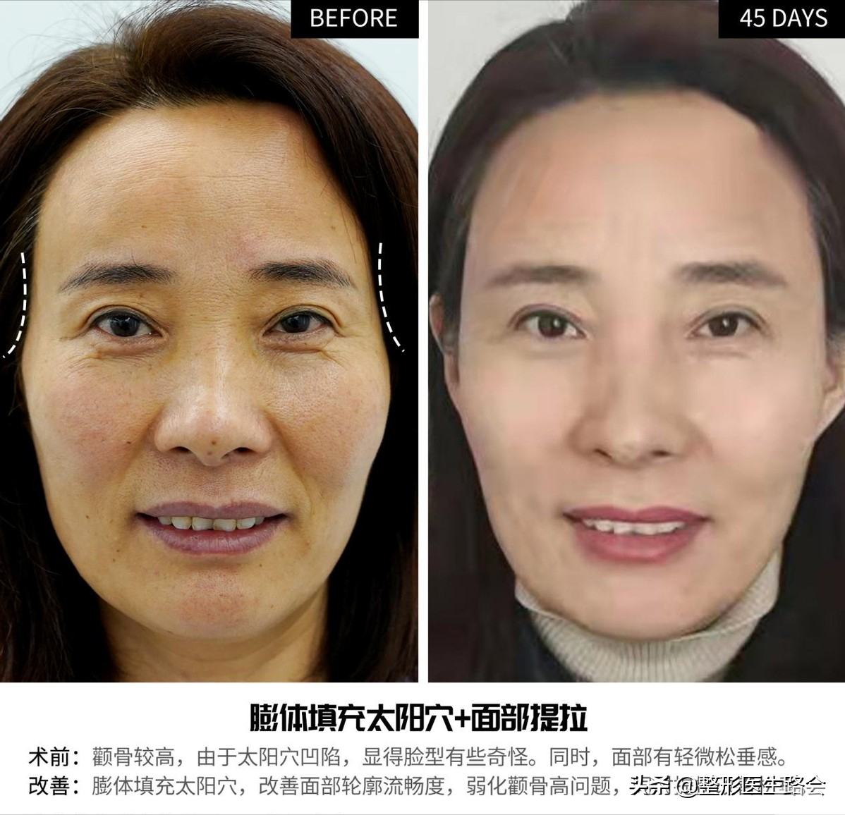 关于玻尿酸隆鼻、填充太阳穴、泪沟,那些医生不会告诉你的 图片-10