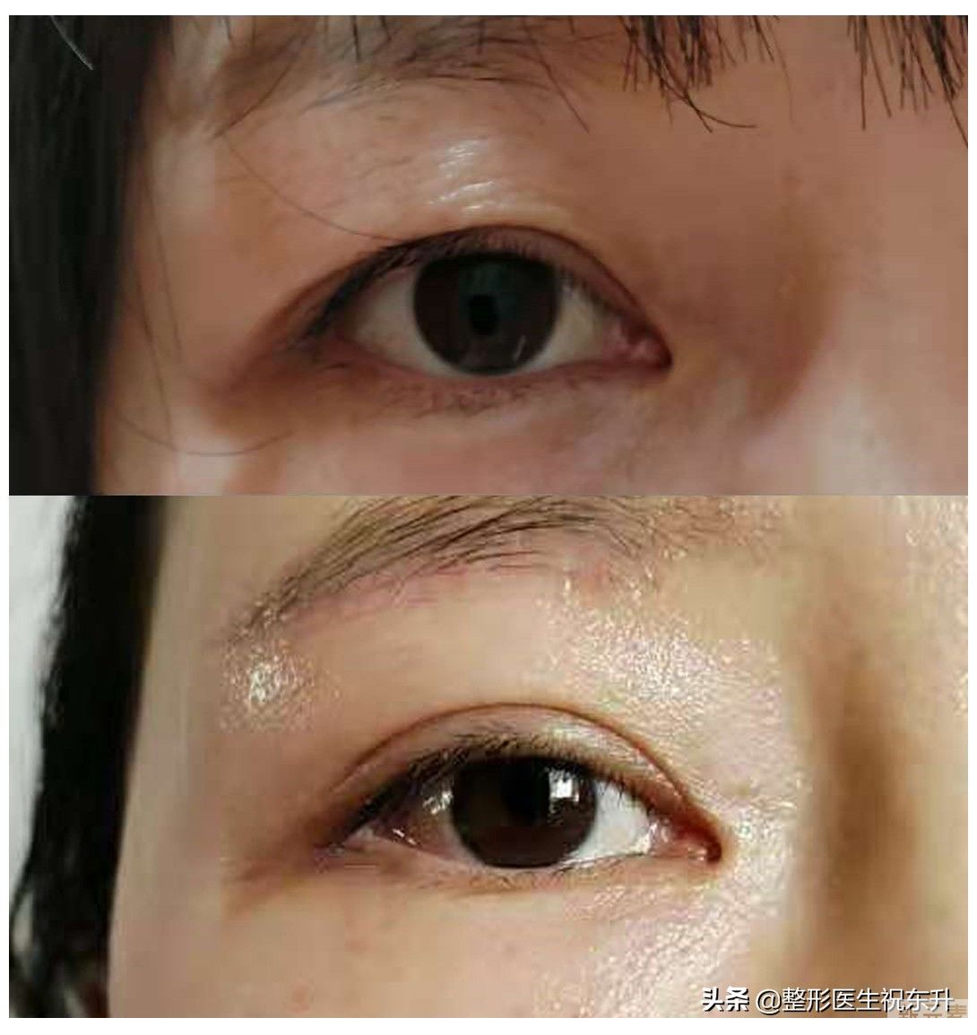 【求美者问】明知道提眉手术是要在脸上开两 图片-1