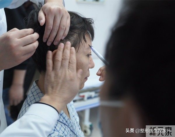 拉皮手术第50天,这实拍图着实惊艳 图片-1