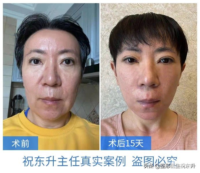 拉皮手术第50天,这实拍图着实惊艳 图片-2
