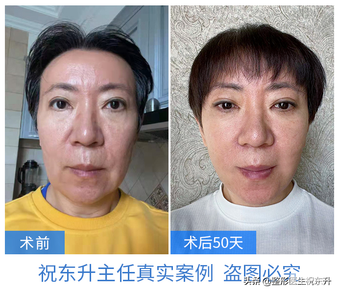 拉皮手术第50天,这实拍图着实惊艳 图片-3