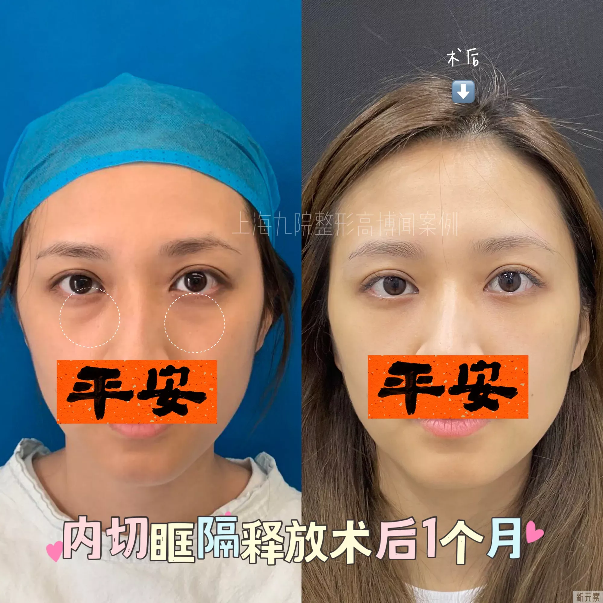 ❓眼袋手术后多久可以运动?做完眼袋手术, 图片-1