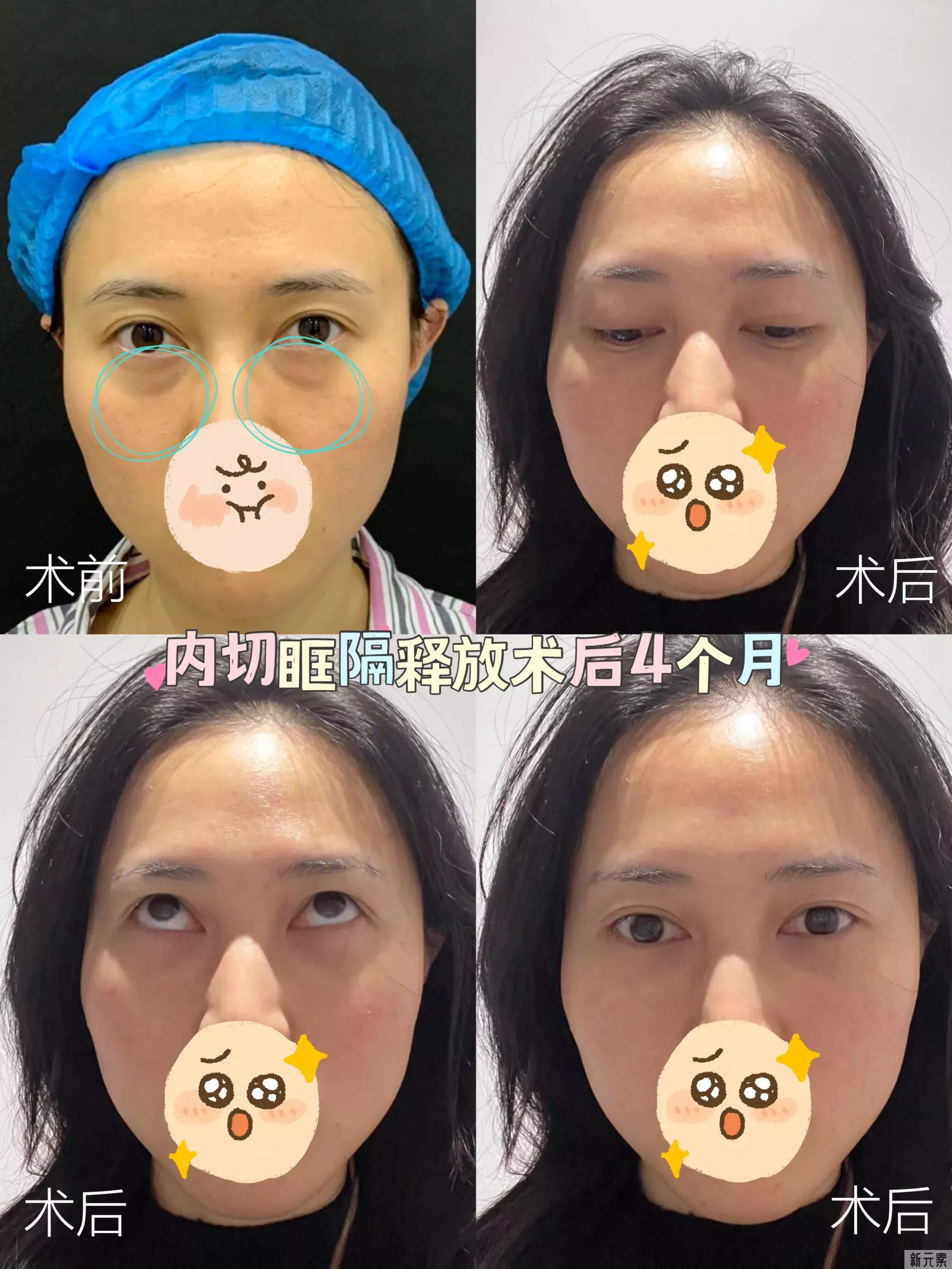 ❓眼袋手术后多久可以运动?做完眼袋手术, 图片-3