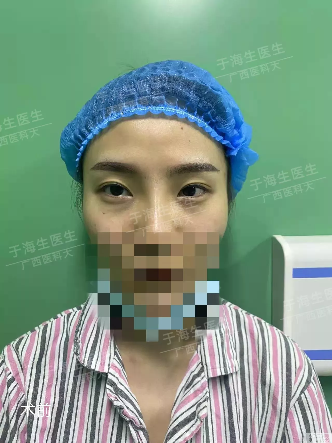 术前眼皮松弛,眼窝凹陷,之前在别的地方做 图片-1