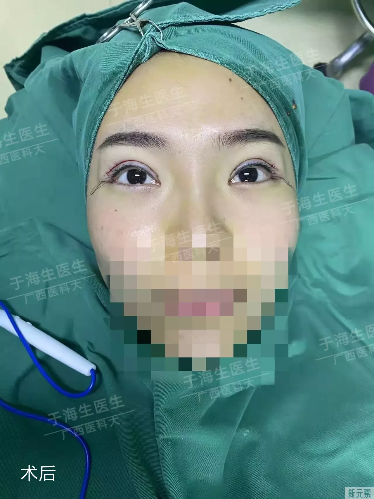 术前眼皮松弛,眼窝凹陷,之前在别的地方做 图片-2
