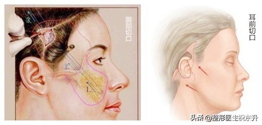 做拉皮手术,不想白花钱?这4点你一定要知道 图片-2