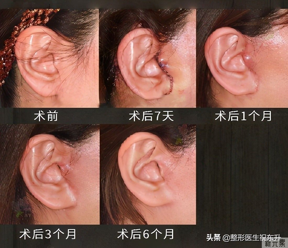 做拉皮手术,不想白花钱?这4点你一定要知道 图片-3