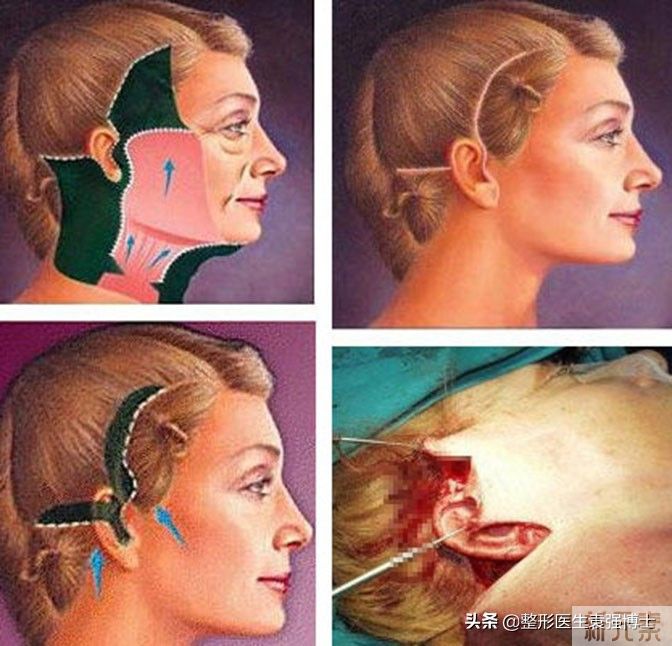 关于拉皮手术,医生总结10件你不知道的事 图片-1