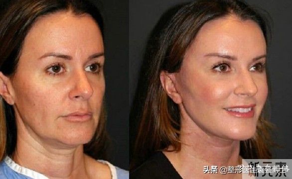 关于拉皮手术,医生总结10件你不知道的事 图片-3