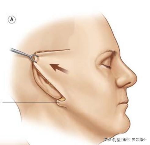 关于拉皮手术,医生总结10件你不知道的事 图片-6