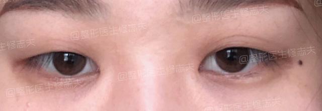 眼睑下垂是不是肌无力症状? 图片-4