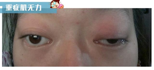 眼睑下垂是不是肌无力症状? 图片-1