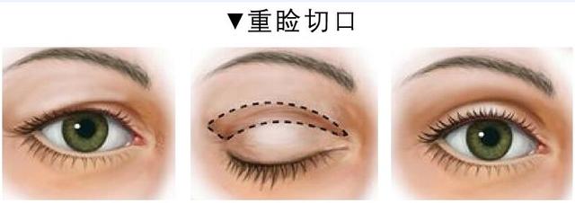 眼睑下垂是不是肌无力症状? 图片-6