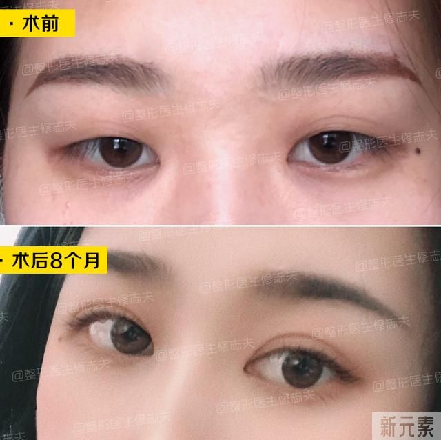 眼睑下垂是不是肌无力症状? 图片-7