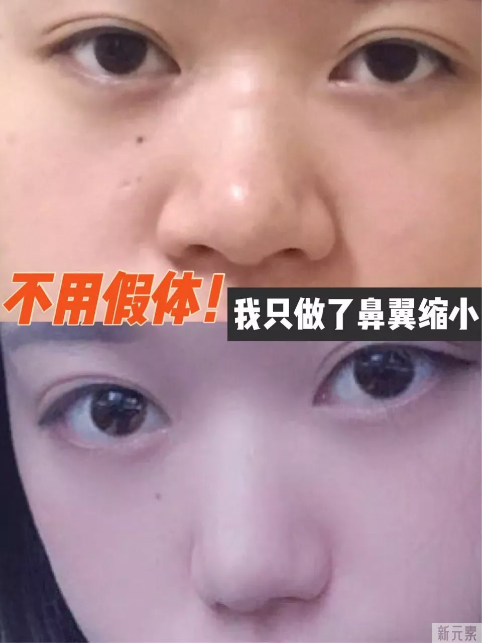 ?明明只做鼻翼缩小就可以变美,为什么很多 图片-1