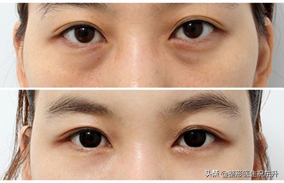 想祛眼袋,内切和外切有什么区别? 图片-1