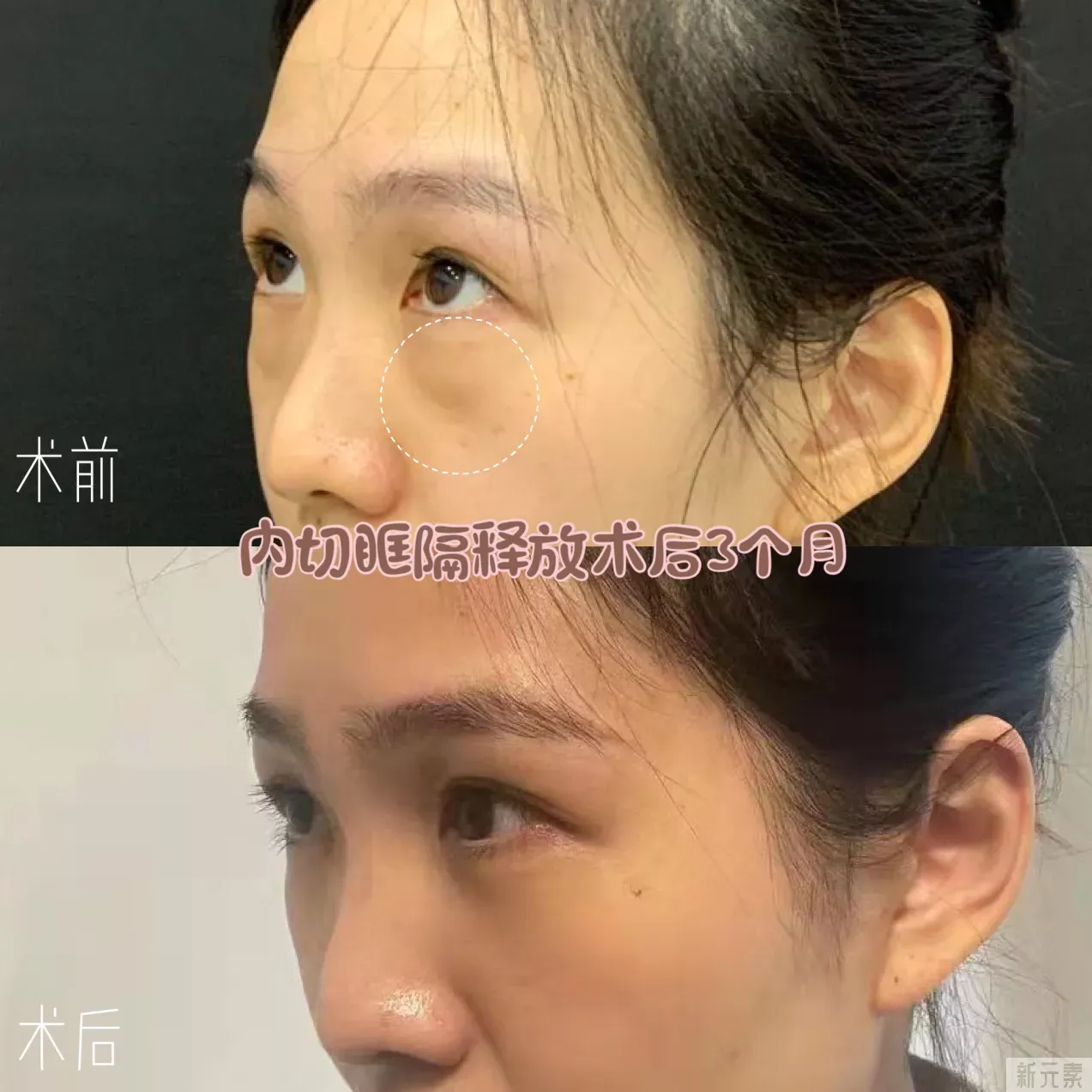 ❓眼袋手术后,多久可以修复? 图片-2