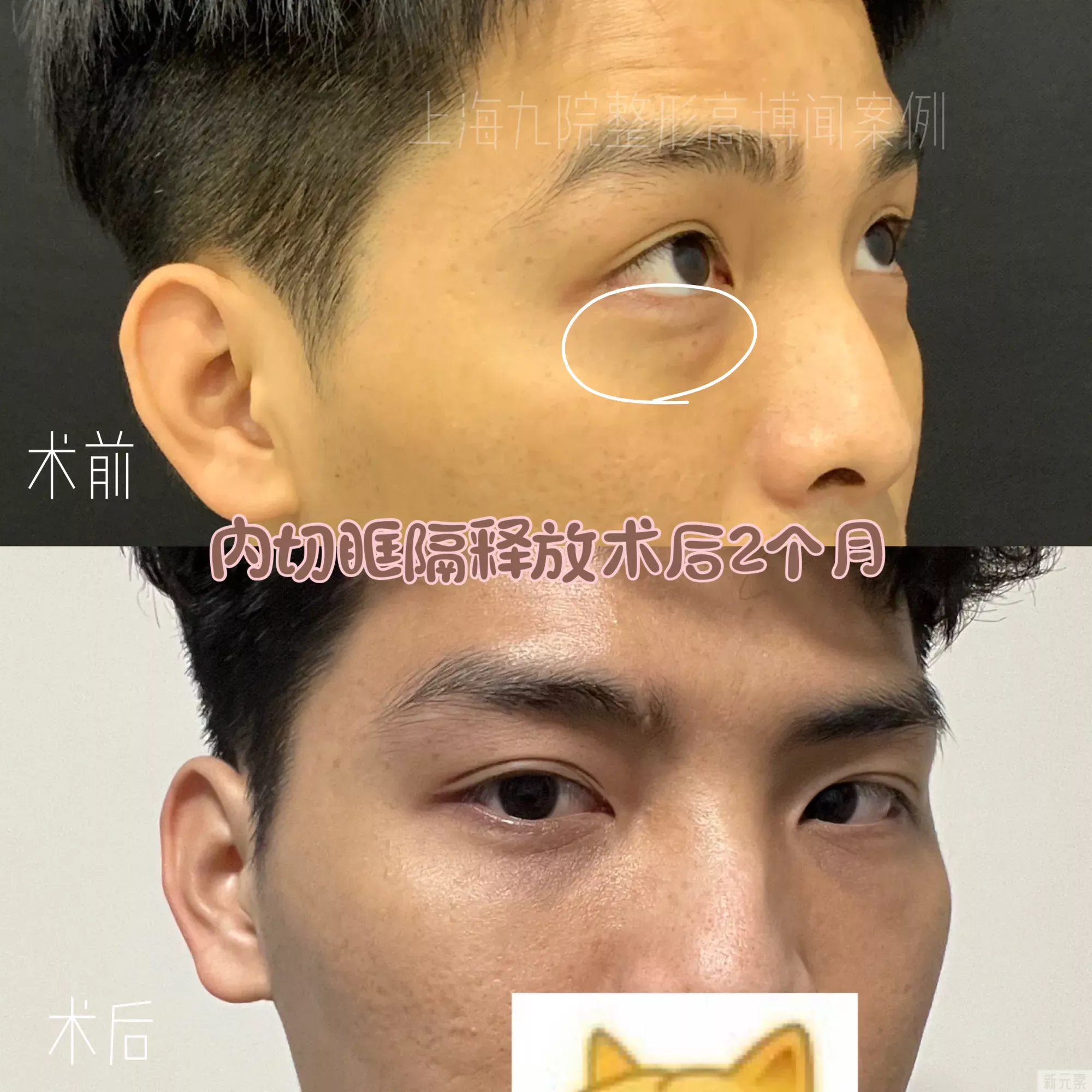 ❓眼袋手术后,多久可以修复? 图片-1