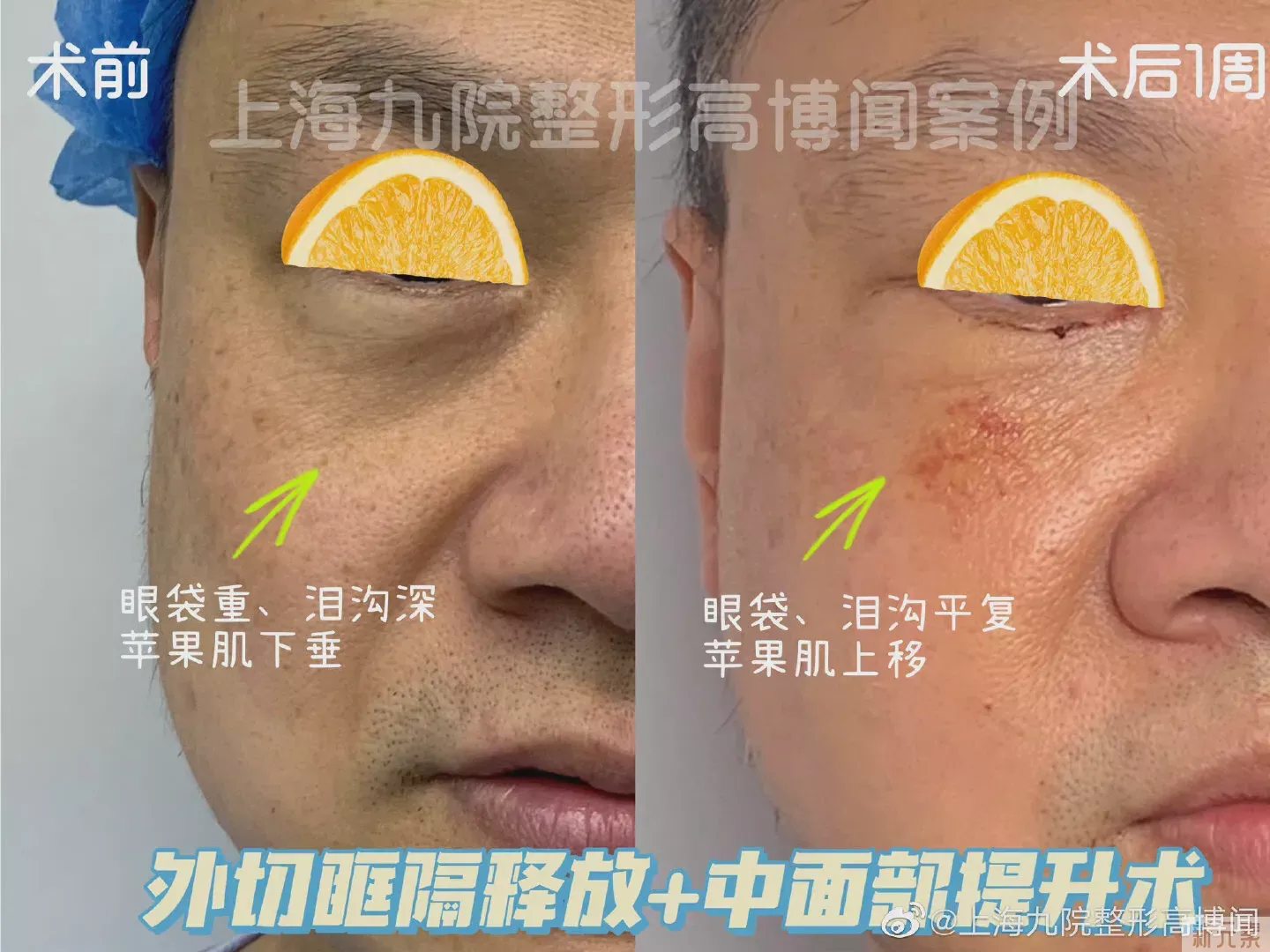 ❓眼袋手术后,多久可以修复? 图片-3