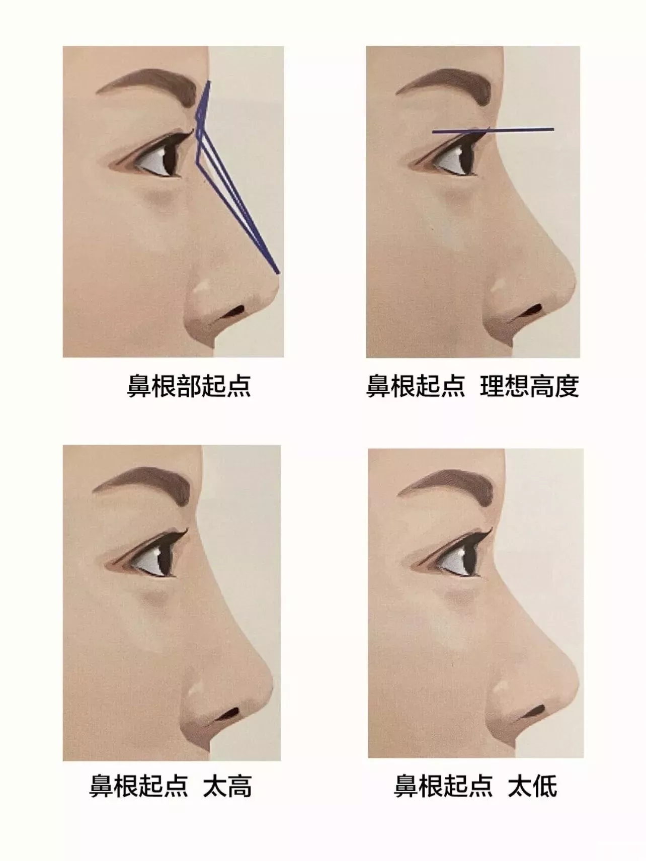 医生眼中的理想妈生自然鼻细节要点! 图片-1