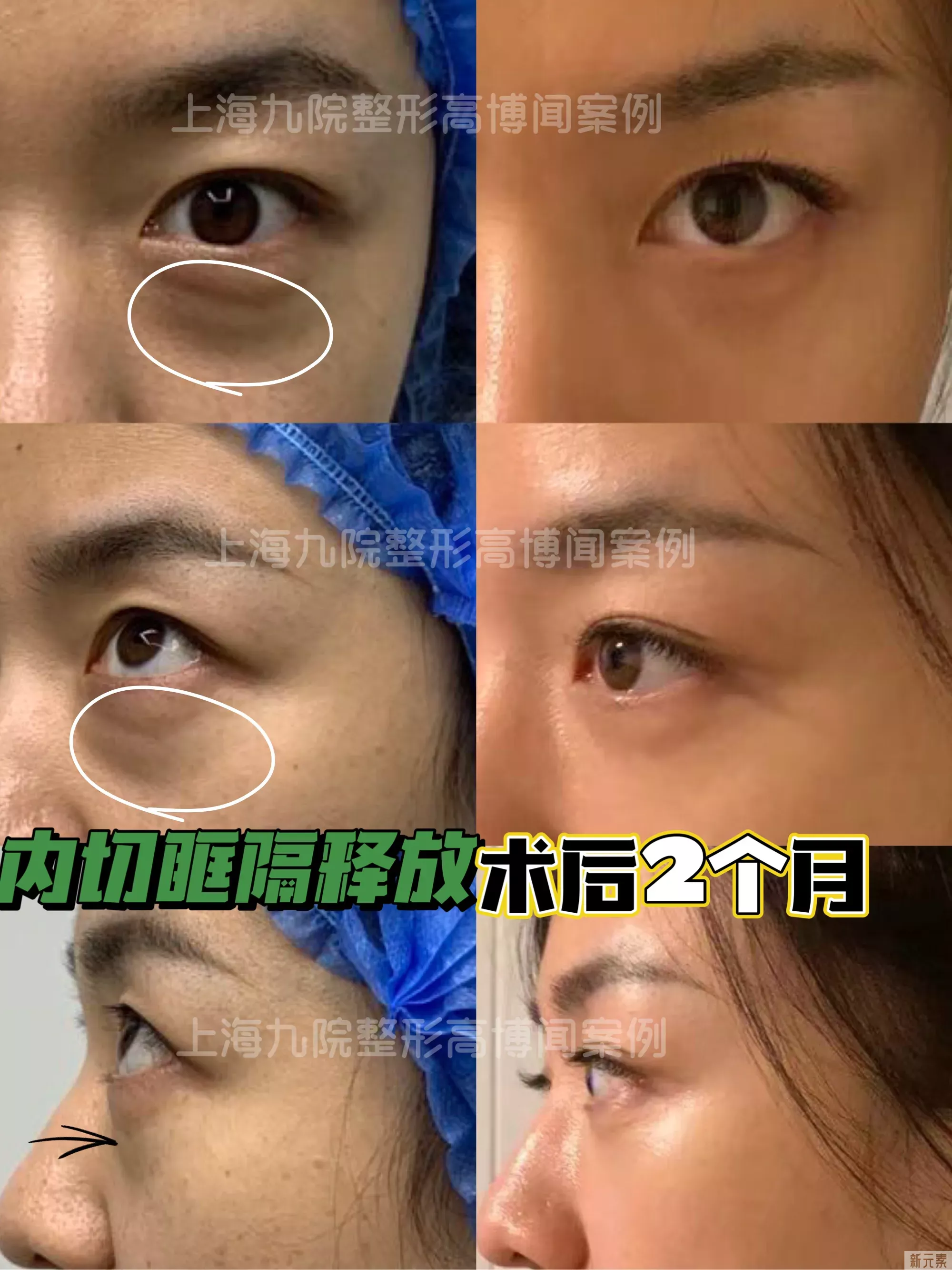 ❓做了眼袋手术多久可以进行眼部按摩? 图片-2