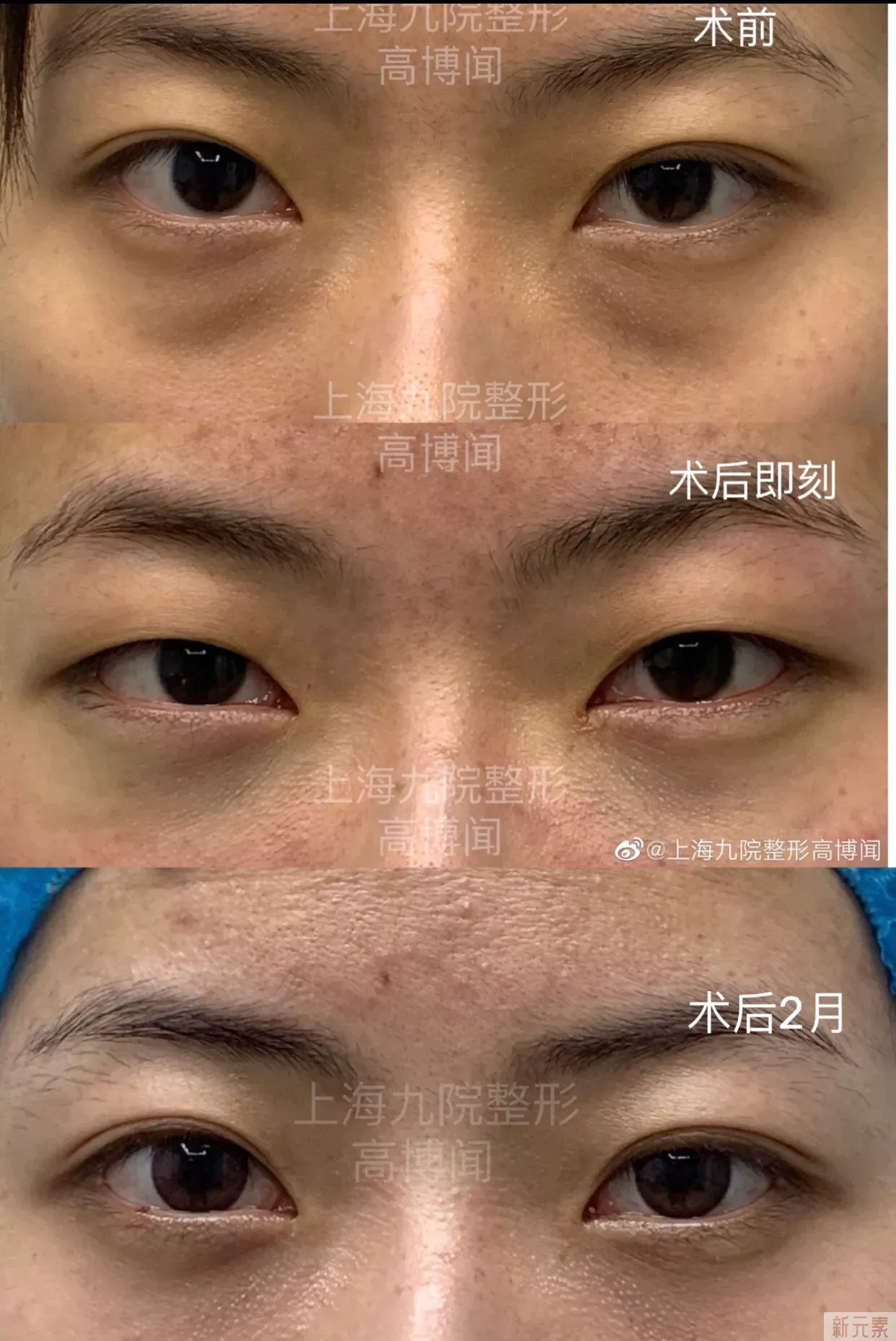 ❓做了眼袋手术多久可以进行眼部按摩? 图片-1