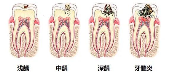 如何有效清洁牙齿?让孩子避免龋齿? 图片-5