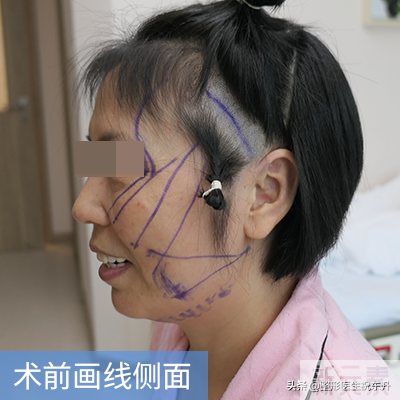 40、50岁的人还适合做小拉皮吗? 45 图片-2