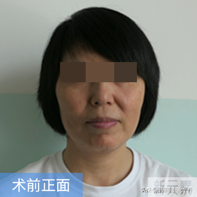 40、50岁的人还适合做小拉皮吗? 45 图片-1
