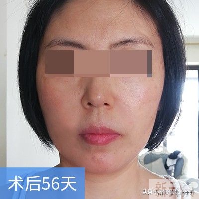40、50岁的人还适合做小拉皮吗? 45 图片-9