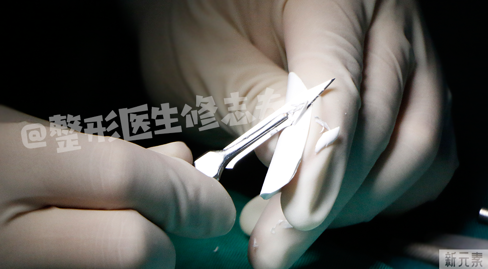 看看,做鼻修复时都从鼻子里取出了什么? 图片-2