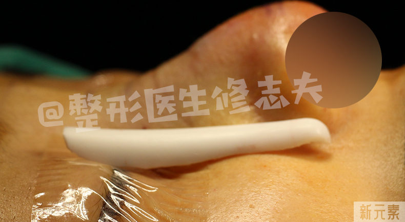 看看,做鼻修复时都从鼻子里取出了什么? 图片-4