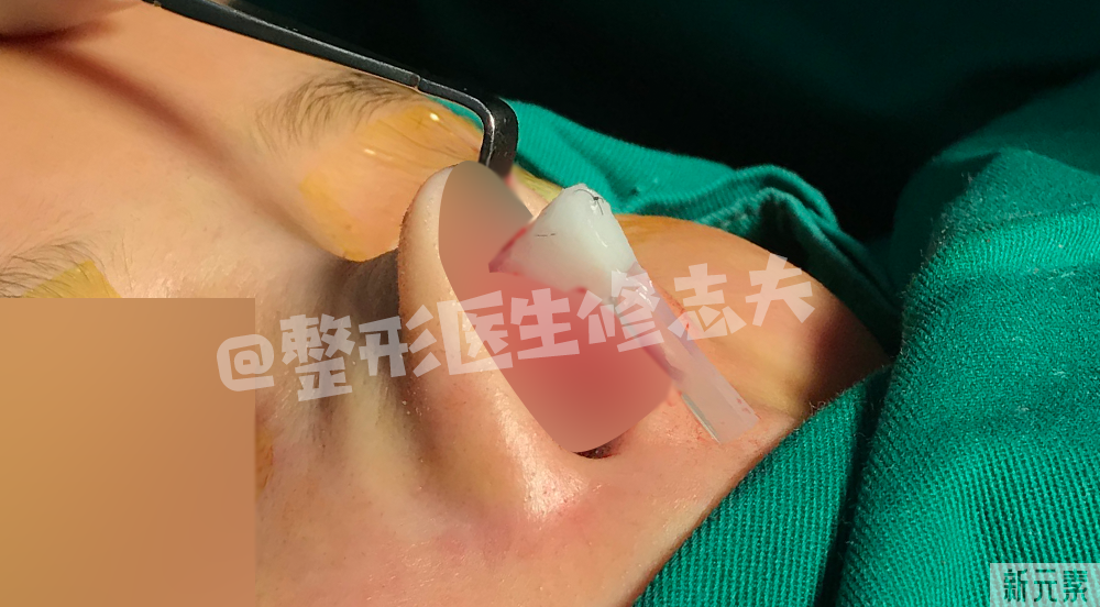 看看,做鼻修复时都从鼻子里取出了什么? 图片-5