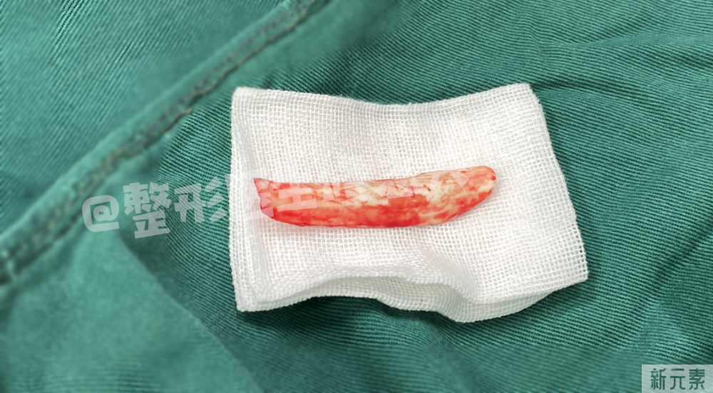 看看,做鼻修复时都从鼻子里取出了什么? 图片-7