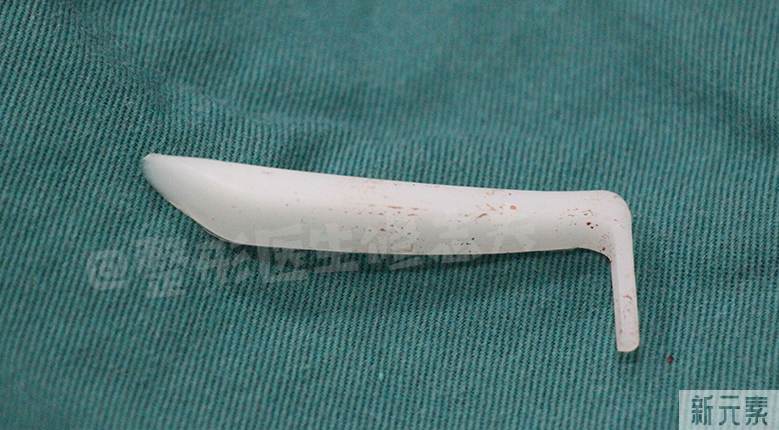 看看,做鼻修复时都从鼻子里取出了什么? 图片-6