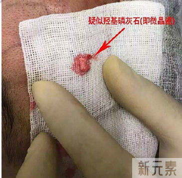 看看,做鼻修复时都从鼻子里取出了什么? 图片-17