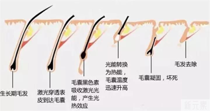 一根不受欢迎的体毛,决定去死,然后...... 图片-4
