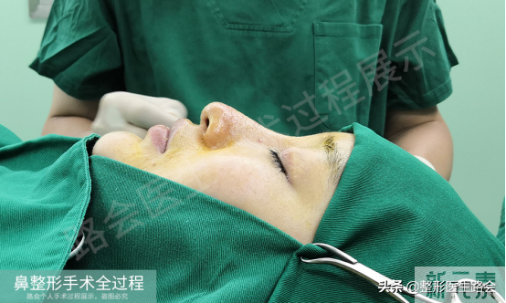 隆鼻手术全过程「真实细节」分享,想要做鼻子的姑娘一定要看看 图片-9